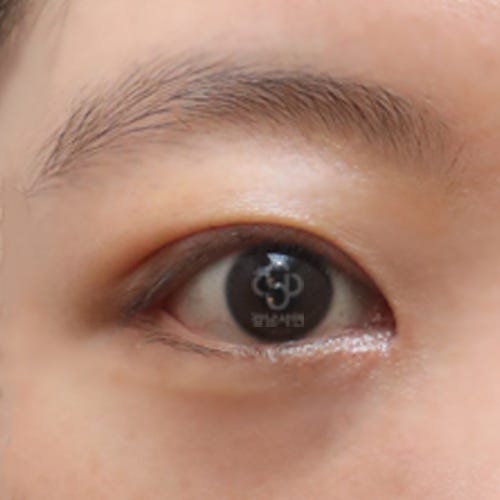 무흉앞트임 이란?