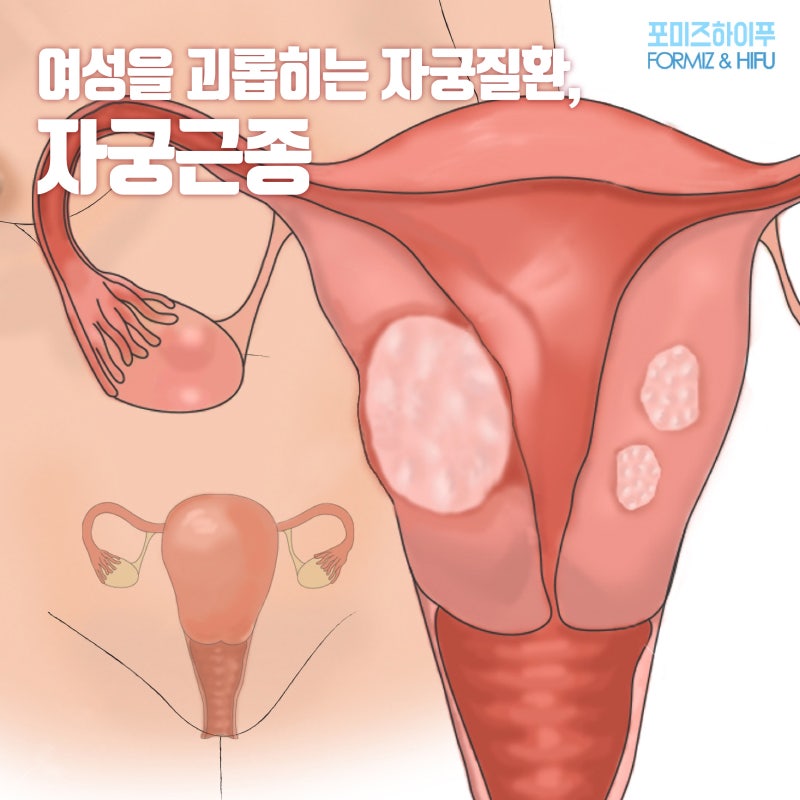 [팔괘 내공] 자궁의 물혹이 사라진다!