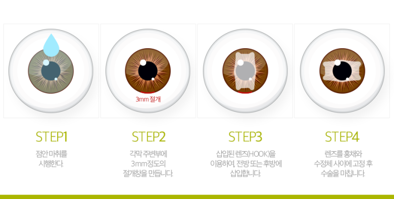 초고도 근시 및 난시에는 인공수정체 이식이 가능한 방법입니다.