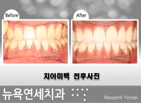  빠르게 하루 만에 해결을 하는 원데이 치아미백 시술 전후보기
