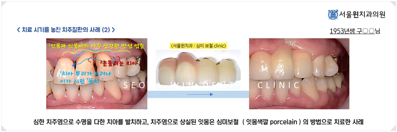 스케일링이 시린 걱정이라면? 6