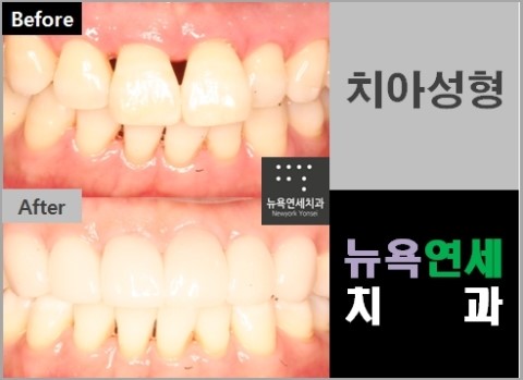  잇몸이 퇴축이 되어 블랙트라이앵글이 생긴 부분도 치아성형으로 해결