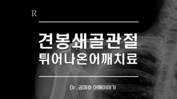  어깨비대칭 어깨로 넘어진 후 견봉쇄골관절탈구 AC joint