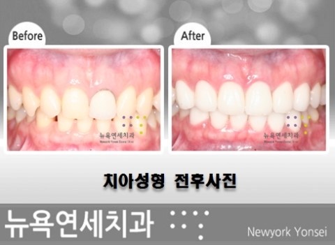  치아성형은 시술 경험이 풍부한 치과에서 검진 후에 결정하세요.