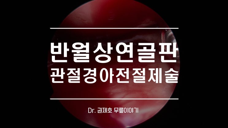  반월상연골찢어짐 시술같은 연골판절제술