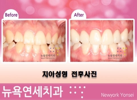  앞니교정을 라미네이트 시술로 보기 좋게 치아성형을 할 수 있습니다.