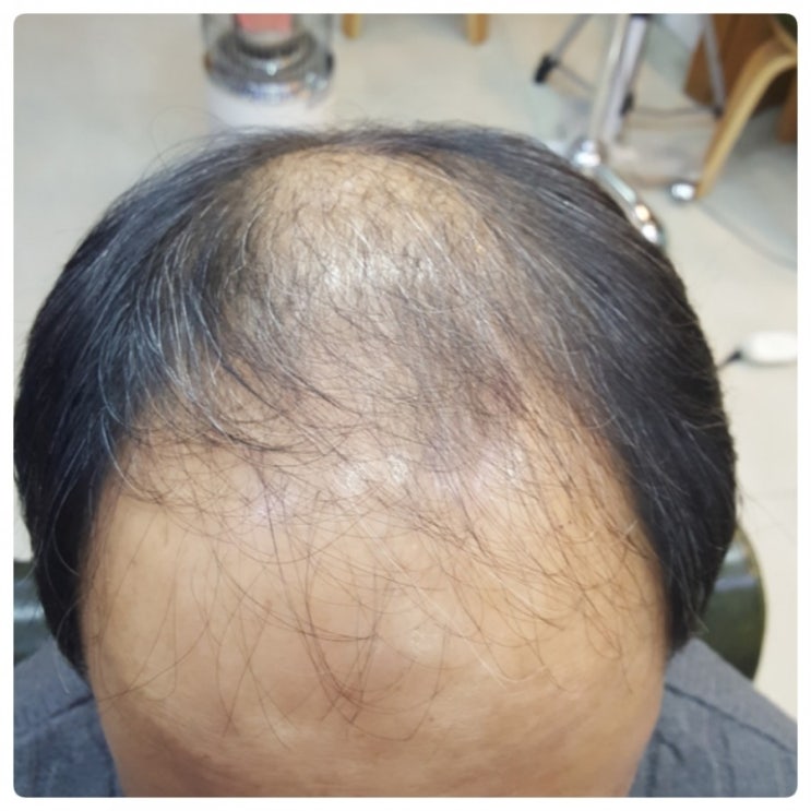  #김호증모가발#춘천가발#가발대여ㆍ중요한행사에 모자쓰고 갈순 없죠~가발대여 합니까?