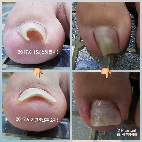 아파도 너무아파!/분당용인수원수지동백보정죽전동/주네일/파고드는발톱 아파도 너무아파!/분당용인수원수지동백보정죽전동/주네일/파고드는발톱