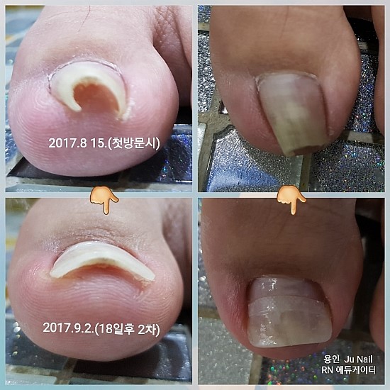 아파도 너무아파!/분당용인수원수지동백보정죽전동/주네일/파고드는발톱 