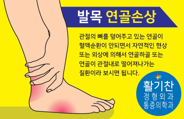 발목 연골 손상 및 지속적인 통증