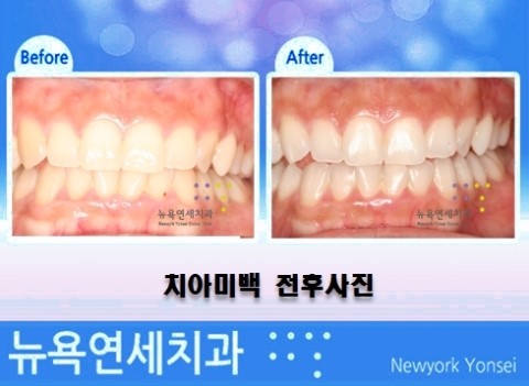  치아미백 종류 중에서 직장인 분들이 많이 하시는 원데이 치아미백!!