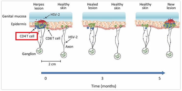  성기 헤르페스와 에이즈 바이러스 (HIV)