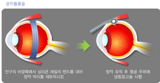 망막박리 이야기 - 2. 수술. 공막 돌륭술 : 네이버 블로그 망막박리 이야기 - 2. 수술. 공막 돌륭술 : 네이버 블로그