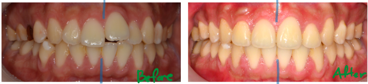 돌출입과 삐뚠 치아의 개선