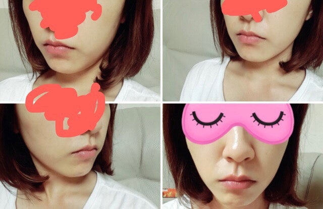 치아교정일기(+412) 땅콩해골얼굴과 함께하는 스크류 2개 더 심기 : 네이버 블로그 치아교정일기(+412) 땅콩해골얼굴과 함께하는 스크류 2개 더 심기 : 네이버 블로그
