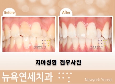  누런 앞니를 치아성형시 치아미백을 같이 하기도 합니다.