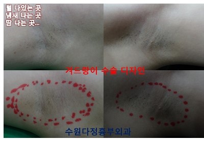 겨드랑이암내제거수술 한번으로 편안 5