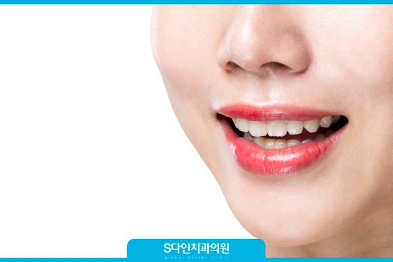 치아교정얼굴변화 얼굴형이 정말 달라질까? : 네이버 블로그 치아교정얼굴변화 얼굴형이 정말 달라질까? : 네이버 블로그