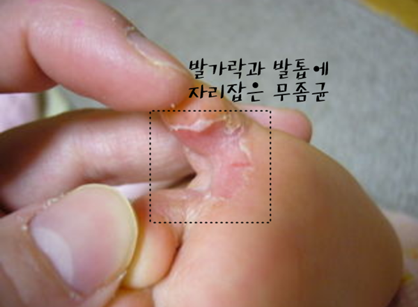  발톱무좀 원인 잡아준 건 타무시친키 골드 아닌 이거! 완치 후기