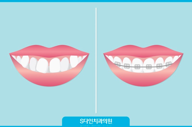 치아교정얼굴변화 얼굴형이 정말 달라질까? : 네이버 블로그