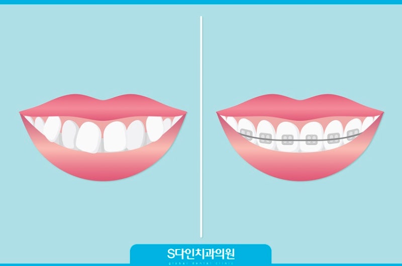 치아교정얼굴변화 얼굴형이 정말 달라질까? : 네이버 블로그 치아교정얼굴변화 얼굴형이 정말 달라질까? : 네이버 블로그