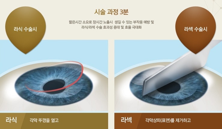 If you're looking for a SmyLASIK procedure