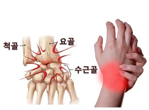 손목 통증, 염증 혹은 인대 파열? 6