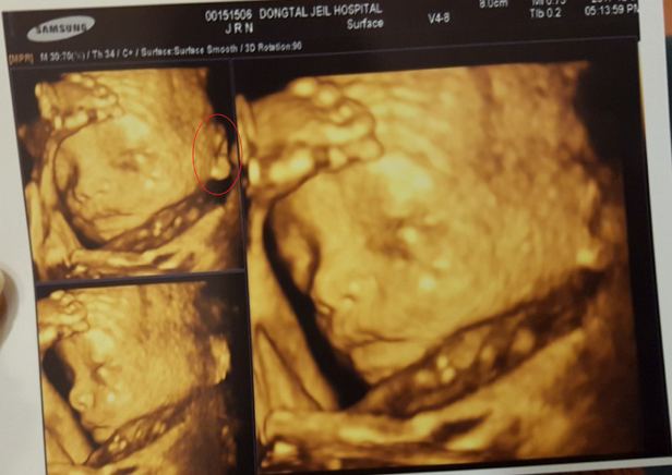 임신일기 : 임신26주 : 입체초음파검사 : 임당검사
