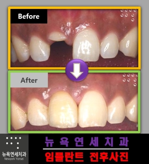 앞니가 없을때는 임플란트 수술로 치아의 기능을 대신 할 수 있습니다.