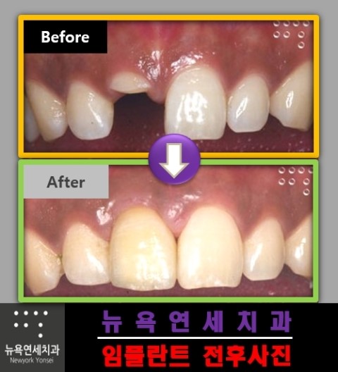  앞니가 없을때는 임플란트 수술로 치아의 기능을 대신 할 수 있습니다.