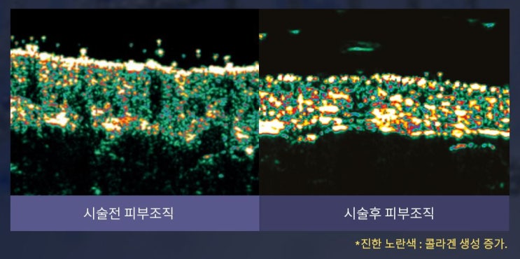  [선정릉역피부과/삼성중앙역피부과/청담역피부과] 필로가주사 (샤넬주사) - 청담ST성모피부과