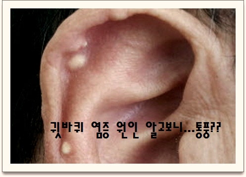 귓바퀴 통증 염증이 생기는 원인은? : 네이버 블로그 귓바퀴 통증 염증이 생기는 원인은? : 네이버 블로그