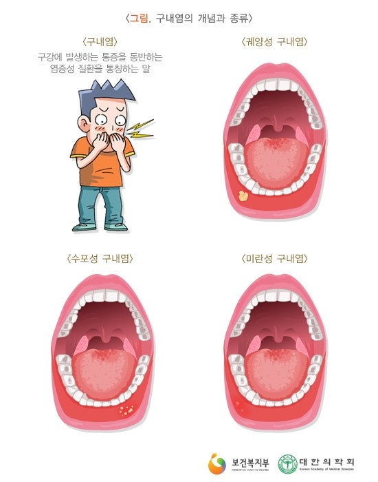 설침알보 바를때마다 통증으로 힘들때 설침약 구내염약 연고패치 대처방법 8