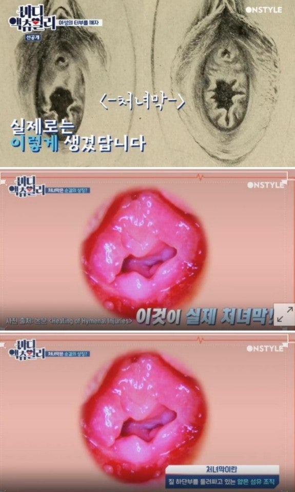 이게 처녀막? : 네이버 블로그 이게 처녀막? : 네이버 블로그
