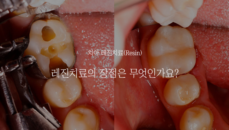 덕천동 치과 치아 레진치료가 뭔가요? 궁금해요! : 네이버 블로그