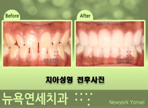  치아가 벌어진 경우에는 앞니성형으로 라미네이트를 할 수 있습니다.