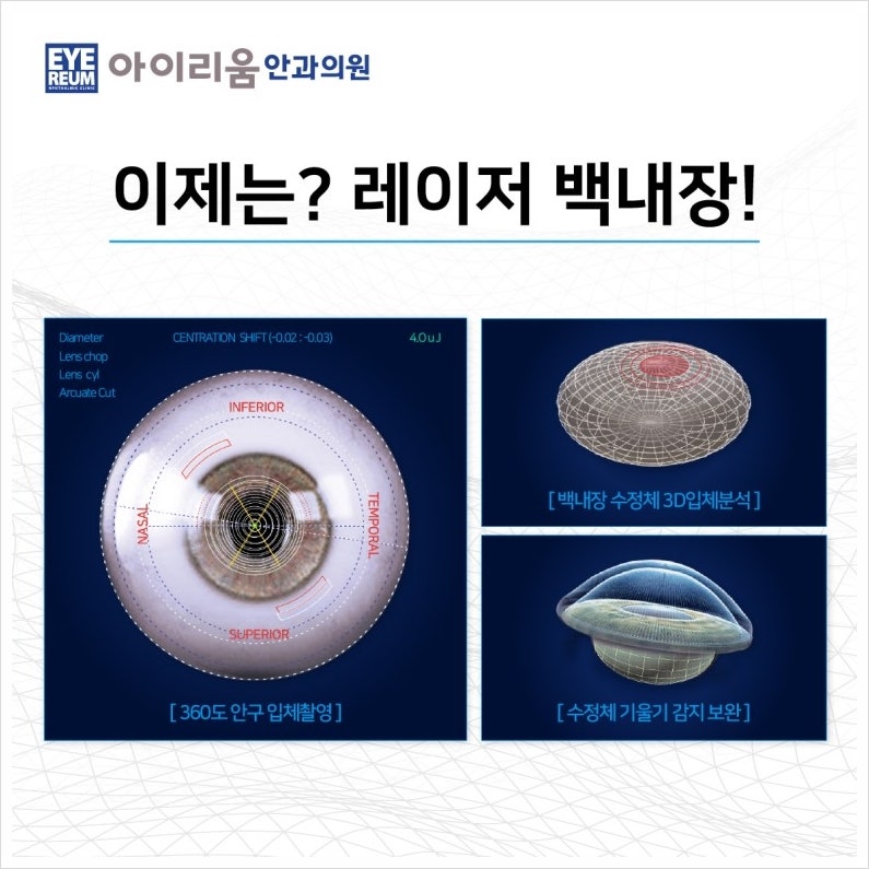 레이저백내장수술, 1:1 수술로 안전성 향상