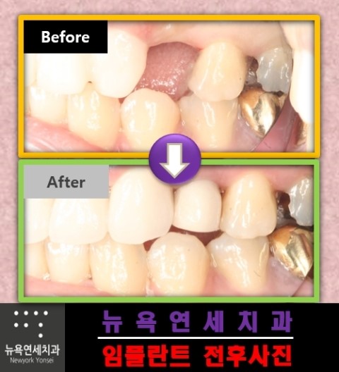 사고로 치아를 잃고 걱정을 하고 계신다면 임플란트 치아로 회복하세요.