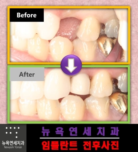  사고로 치아를 잃고 걱정을 하고 계신다면 임플란트 치아로 회복하세요.