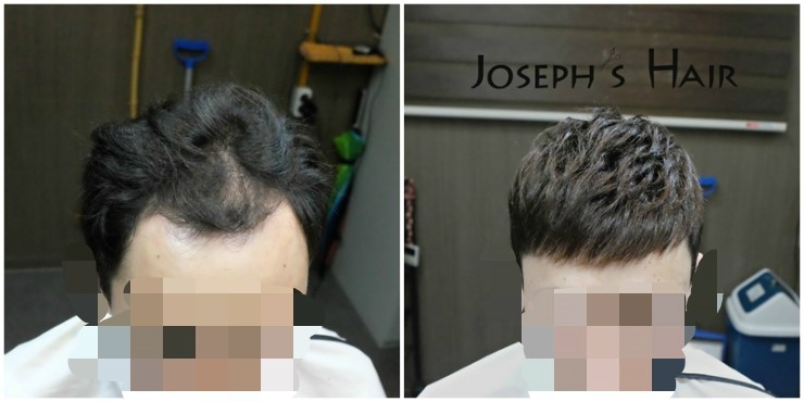 울산 남자가발, 정수리 탈모 맞춤가발로 완벽 보완! 7