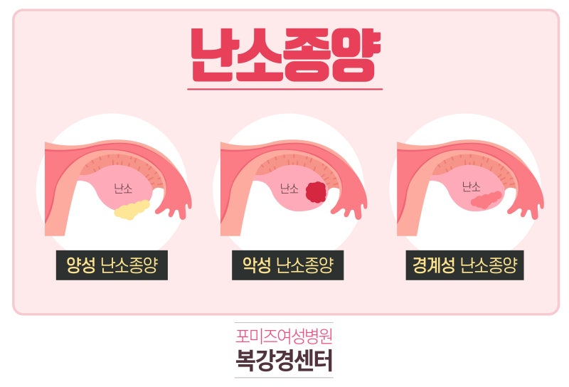난소경계성종양 종류와 증상까지