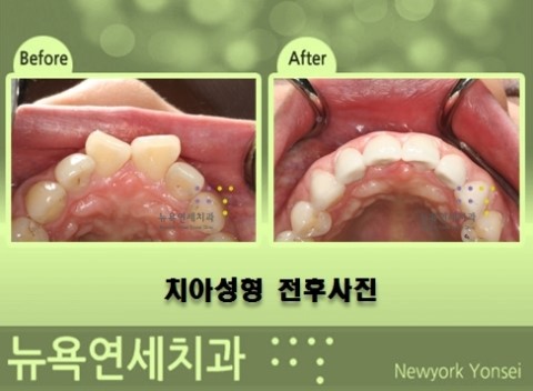  앞니 치아성형은 어떤 경우에 치료를 할 수 있나요?