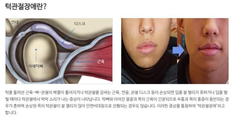 송도턱관절병원 턱이 아픈 이유 5