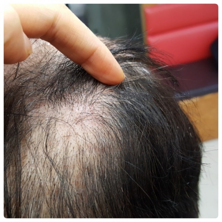  가발클립으로 머리가 빠졌어요~좋은방법 있을까요?..SOS