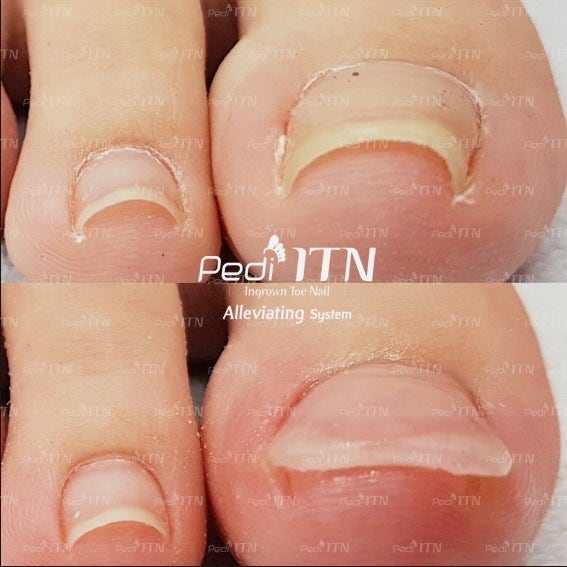 부산피부과 전문의 피부 파고드는 내성손톱 3