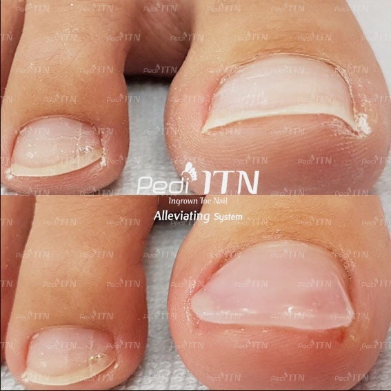 부산피부과 전문의 피부 파고드는 내성손톱