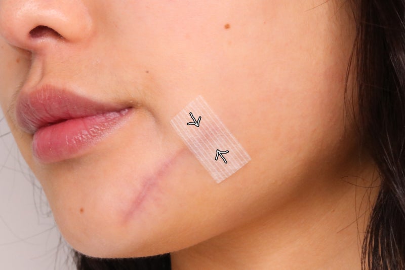 대학병원 흉터제거 치료 후기 2