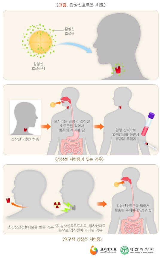 [TSH 값 높다] 무증상 갑상선기능저하증(불현성) 정의, 원인, 치료대상, 치료방법, 추적관찰방법