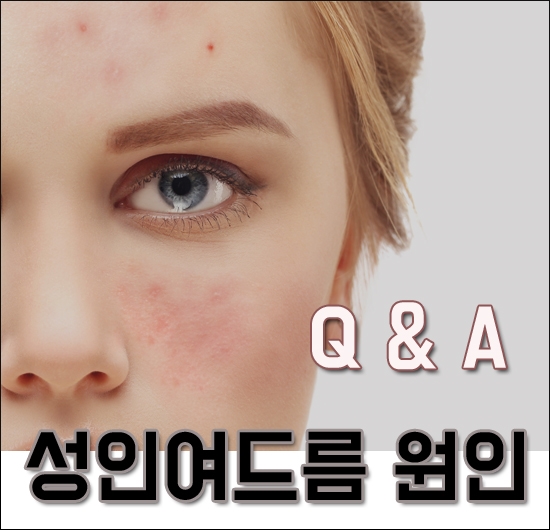  얼굴 가장자리로 올라오는 성인여드름원인
