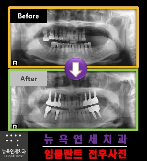  임플란트 수술을 할때 왜 뼈이식을 해야 하는지요?